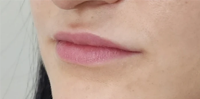 1. lip filler before (1)