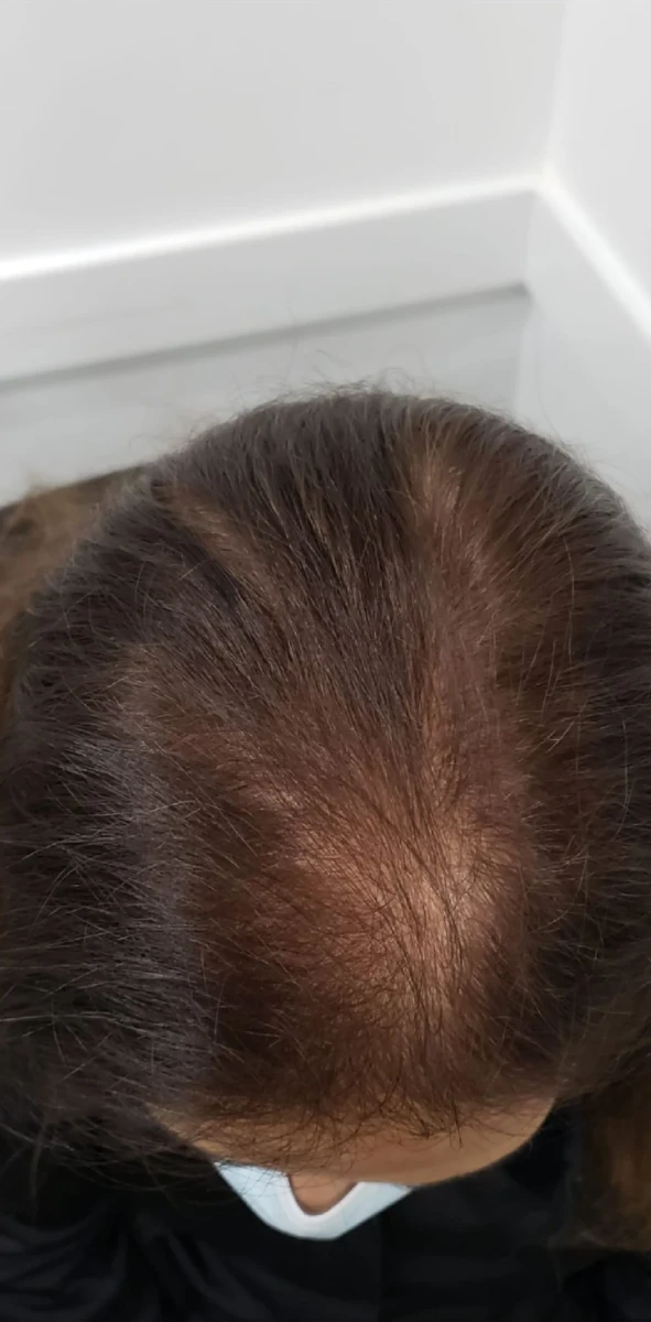 Top view of a person's head showing noticeable thinning hair at the crown area, highlighting the potential benefits of New Westminster PRP Hair Restoration.