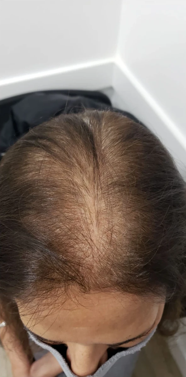 A top view of a person's head reveals thinning hair with a visible scalp, set against a light-colored wall and floor, emphasizing the need for New Westminster PRP Hair Restoration.