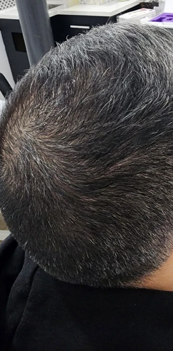 Close-up view of the top of a person's head reveals short-cropped, graying hair and a bald spot, highlighting the potential benefits of New Westminster PRP Hair Restoration.