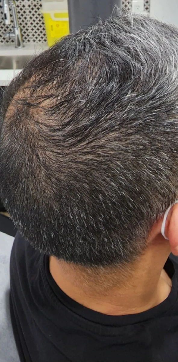 A close-up of the back of a person's head reveals short, graying hair, perhaps seeking New Westminster PRP Hair Restoration.