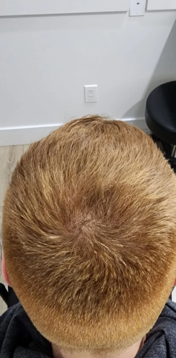 Top view of a person's head with short, light brown hair, focused on the crown area. A black chair and part of the white wall are visible in the background, reminiscent of a New Westminster PRP Hair Restoration setting.