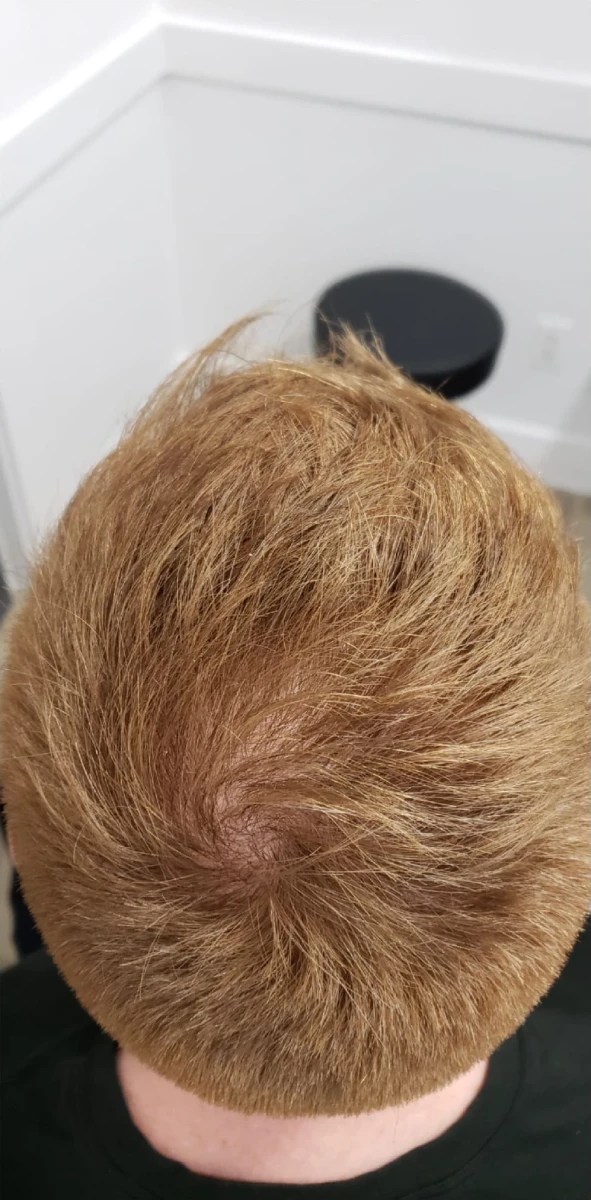 Top view of a person with light brown hair, highlighting a thinning area on the crown of the head, potentially suitable for New Westminster PRP Hair Restoration. A black stool is visible on the gray floor in the background.
