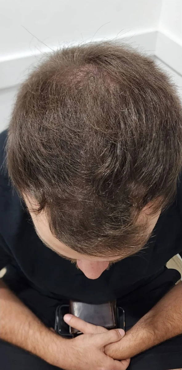 A person with thinning hair sits in New Westminster, gazing intently at a phone held in both hands, perhaps considering PRP Hair Restoration options.