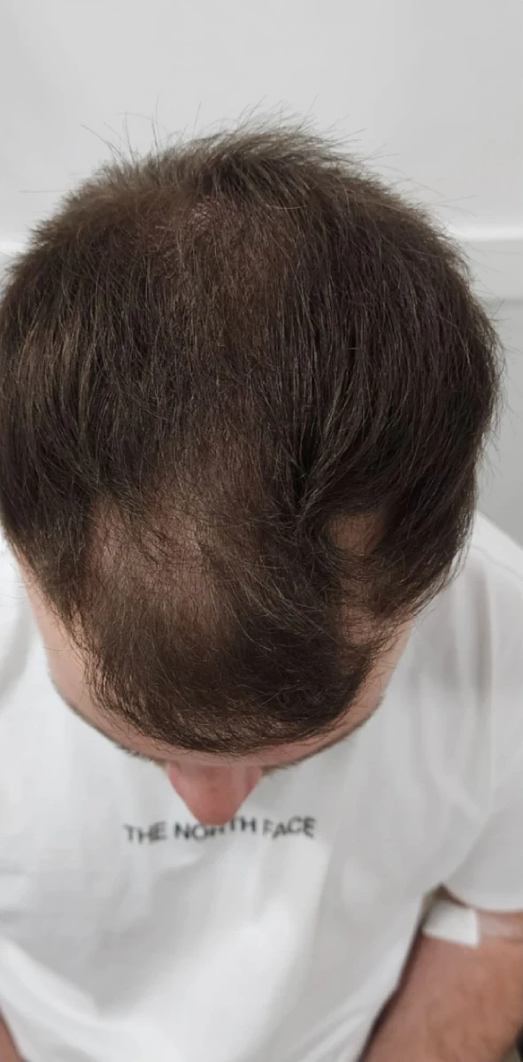 A person with thinning hair on top of their head, wearing a white shirt with visible text, is seen from above. They might be considering New Westminster PRP Hair Restoration for a fuller look.