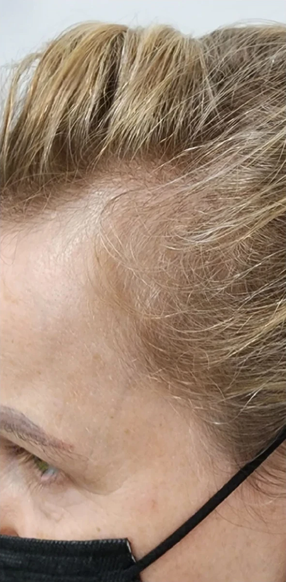 Close-up of a person's forehead and hairline, showcasing light brown hair with some thin strands, possibly perfect for New Westminster PRP Hair Restoration. The person is wearing a black face mask.