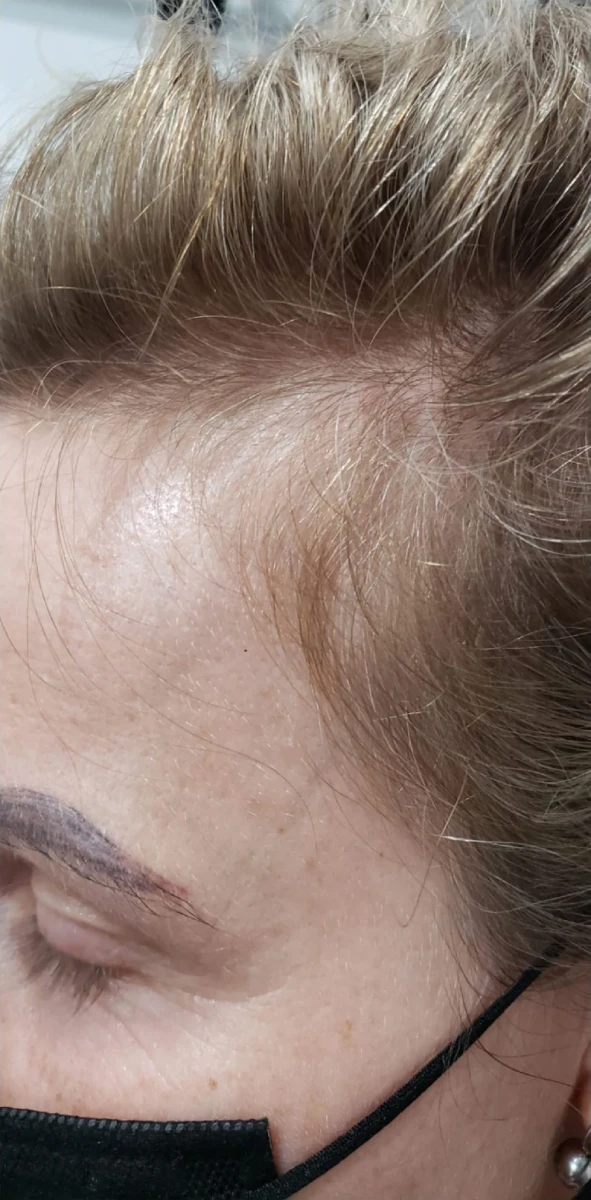 Close-up of a person's face in profile, showcasing their forehead, eyebrow, and light brown hair—a testament to New Westminster PRP Hair Restoration. They wear a black face mask.