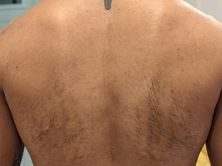 A close-up of a person's back showcases intricate tattoos intertwined with patches of hair on the shoulders and upper back, a canvas soon to be treated by New Westminster Laser Hair Removal.